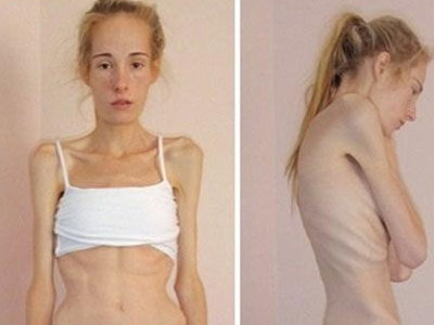 Cô gái "gầy xiêu gầy đổ", suýt chết vì chứng biếng ăn năm xưa giờ ra sao?
