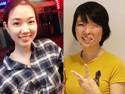 Hành trình một năm tái tạo gương mặt cho nữ sinh bị tạt axit ở Sài Gòn