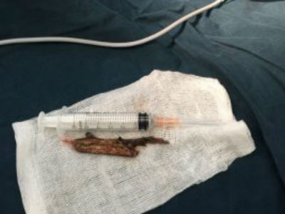 Chơi đùa ngã vào bụi cây, bé trai 9 tuổi bị nhánh cây đâm xuyên cổ