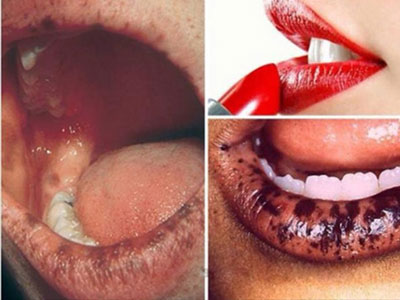 Giám đốc BV Da liễu TW: “Mẹ bầu dùng son môi nhiễm độc chì, con dễ mắc biến chứng tâm thần, dị dạng”