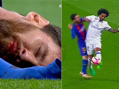 Messi đổ máu, gãy răng khi va chạm với Marcelo