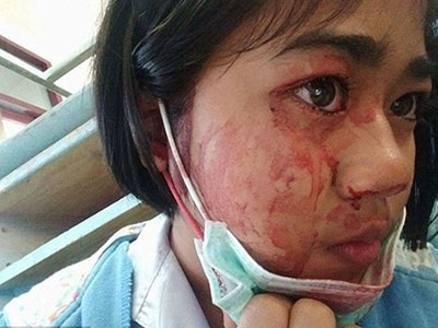 Mắc quái bệnh, bé gái cứ đau đầu căng thẳng là đổ mồ hôi máu
