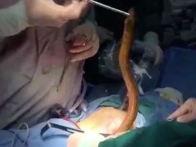 Bác sĩ kéo lươn khổng lồ ra khỏi bụng bệnh nhân