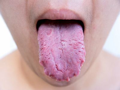 Điều gì xảy ra nếu bạn không vệ sinh lưỡi