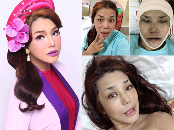 Cindy Thái Tài tiếp tục sửa mũi lần 5, "đập đi xây lại" toàn bộ mặt