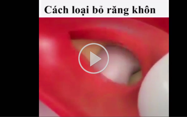 Video: Bác sĩ loại bỏ răng khôn mọc lệch của bạn thế nào