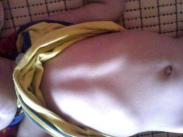 Mẹ chủ quan không nghe lời bác sĩ khiến con mang dị tật ngực ức gà