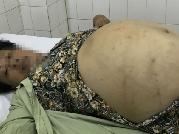 Người phụ nữ mang khối u buồng trứng gần 20 kg