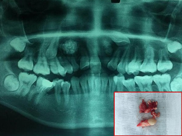 14 tuổi vẫn còn răng sữa, đi khám phát hiện u răng với hàng chục chiếc răng nhỏ