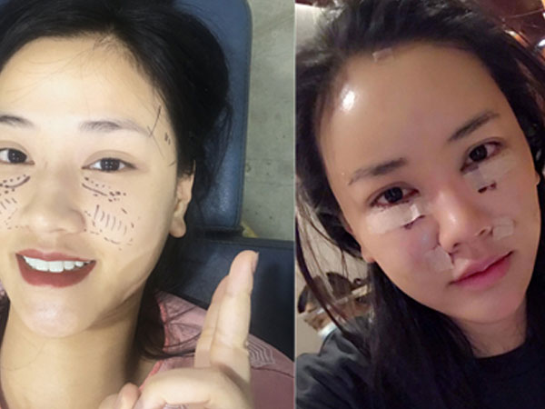 Maya bất ngờ lộ ảnh mặt sưng phù khi đi thẩm mỹ ở Hàn Quốc