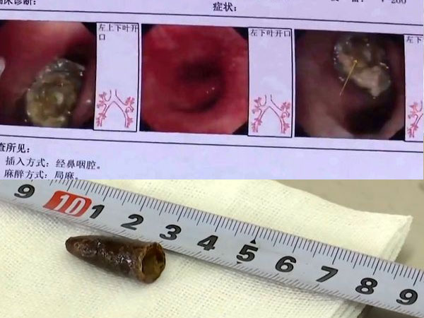 Tìm thấy nắp bút biến dạng kẹt trong phổi gần hai thế kỷ