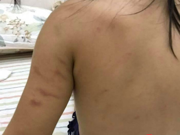 Bé mầm non 2 tuổi bị bầm tím do… cô giáo xử trí chưa "linh hoạt, tinh tế"