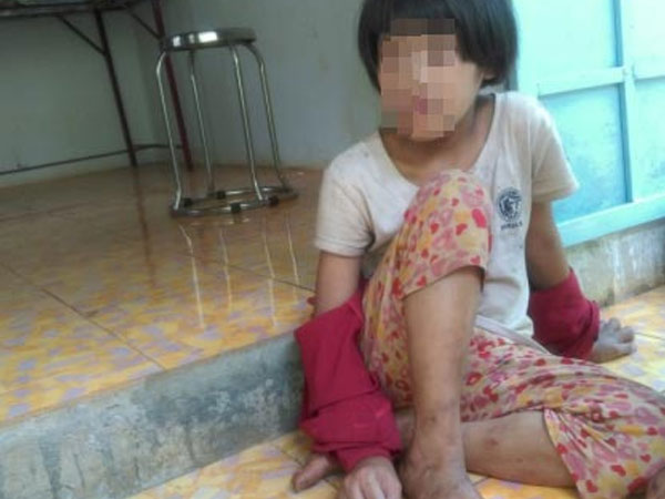 Cuộc sống hiện tại đáng thương của bé gái từng bị mẹ cắt gân chân