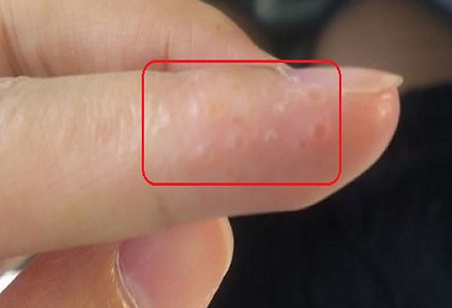 Dấu hiệu trên ngón tay chứng tỏ lục phủ ngũ tạng tích độc tố: Nên biết để thải độc ngay