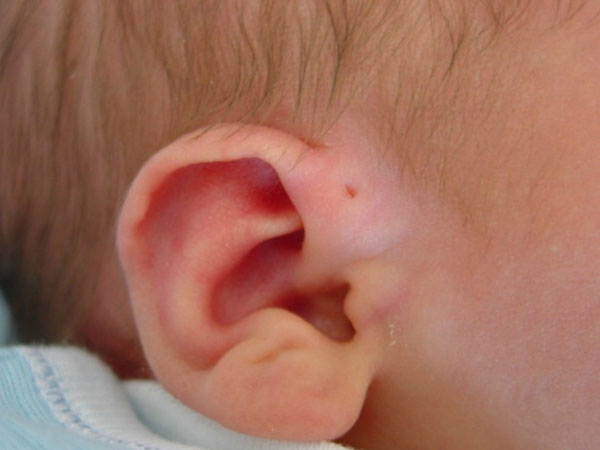 Mẹ cứ ngỡ con có lỗ nhỏ ở vành tai là thông minh nhưng sự thật lại rất nguy hiểm