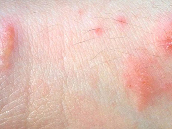 Phát ban sinh dục: Có chữa khỏi được không?