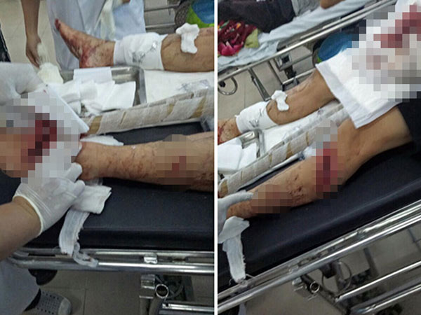 Bênh vợ bị đánh, chồng bị nhóm “giang hồ” chém nhập viện