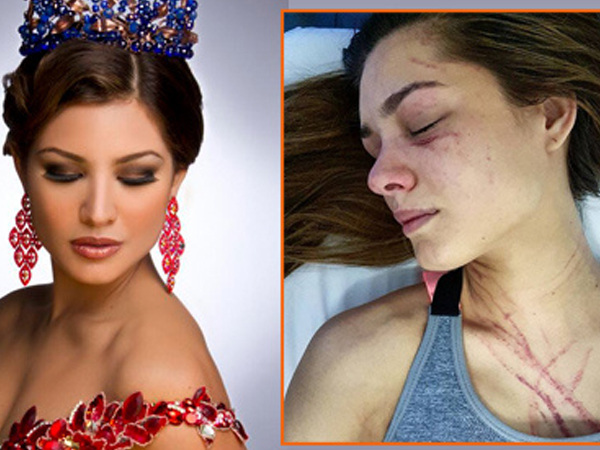 Hoa hậu Trái đất bị nữ ca sĩ Venezuela đánh trọng thương