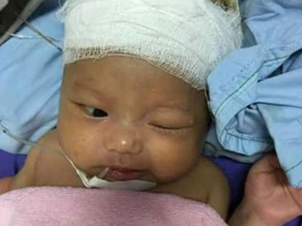 Quảng Ninh: Phẫu thuật ghép sọ não thành công cho bé trai 37 ngày tuổi