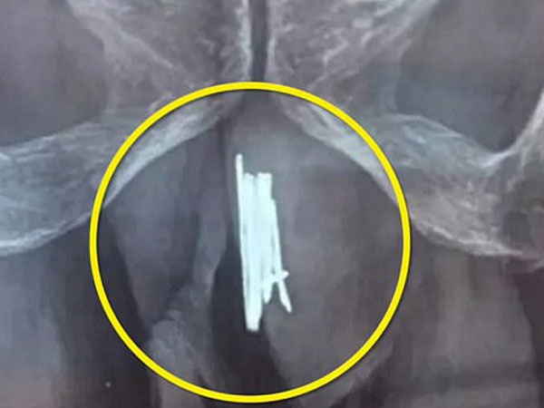 Bác sĩ toát mồ hôi khi mổ gắp 15 cây kim cho quý ông thích "tự sướng"