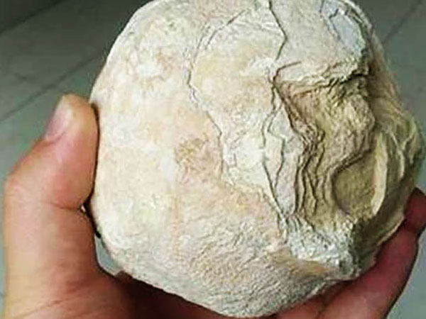 Đi tiểu ra máu, người phụ nữ mới đi khám và phát hiện ra "quái vật" này trong bụng