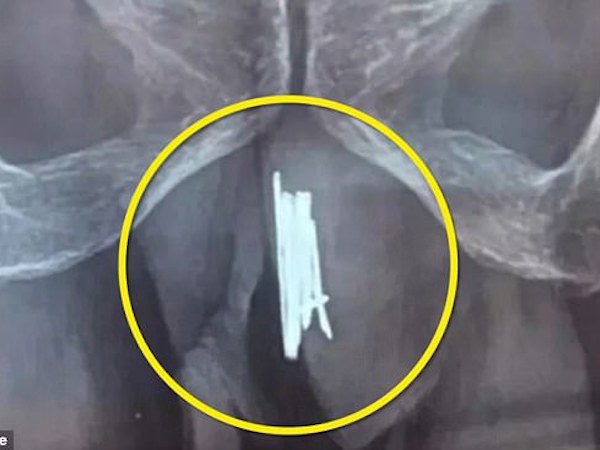 Kinh dị người đàn ông nhét 15 cây kim vào của quý