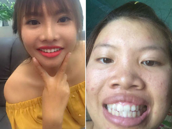 Phượng "Thị Nở" khoe răng cũ để PR răng mới nhờ chi tiền "khủng"?