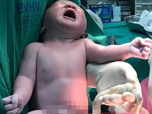 Sản phụ sinh bé trai mang vòng dây rốn thắt nút hiếm gặp