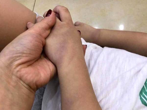 Xôn xao bé trai 3 tuổi ở Hải Dương bị giáo viên đánh bầm tím chân tay