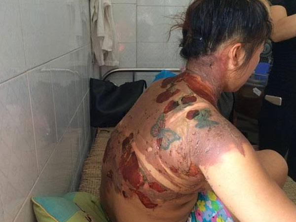 Dội nước sôi vào người vợ rồi thản nhiên bỏ đi