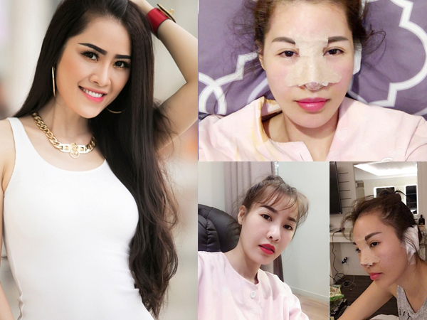 Quế Vân chi 400 triệu để sửa mặt lần hai