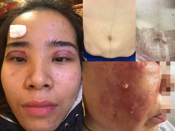 Chi 15 triệu làm đẹp sau sinh ở spa, mẹ trẻ bị bắn laser chín thịt, bụng chi chít sẹo bỏng