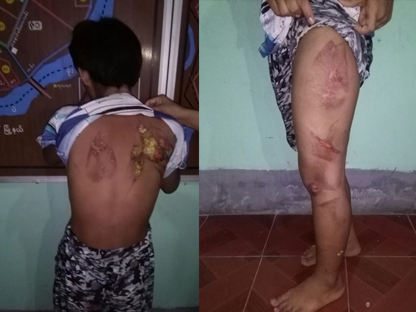 Cô bé 13 tuổi đi làm giúp việc bị chủ nhà dùng bàn là nóng bạo hành rồi đổ nước sôi lên người