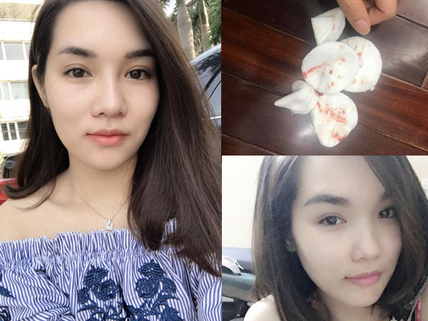 Ham làm đẹp bằng phương pháp tiêm filler, cô gái trẻ bị vẹo mũi, bóp ra đầy dịch vàng vón cục lẫn máu