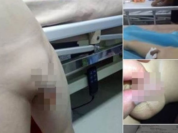 Hưng Yên: Cho con đi cắt bao quy đầu, mắc bệnh sùi mào gà