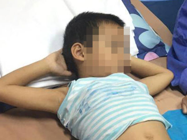 Sùi mào gà, căn bệnh chủ yếu lây qua tình dục, đã truyền sang trẻ em thế nào?