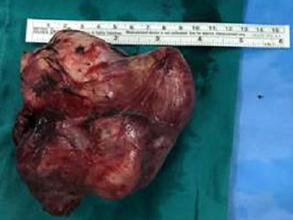 TP.HCM: 3 tiếng cắt trọn khối u quái khổng lồ cứu sống bé trai 2 tuổi