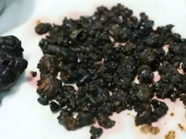 200 viên sỏi mật trong bụng người phụ nữ thường bỏ bữa sáng