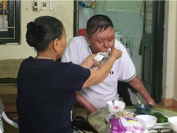 Chiến sỹ sống sót vụ máy bay rơi Hòa Lạc: "Có hiến cho tôi tay thật cũng khó ghép nổi"