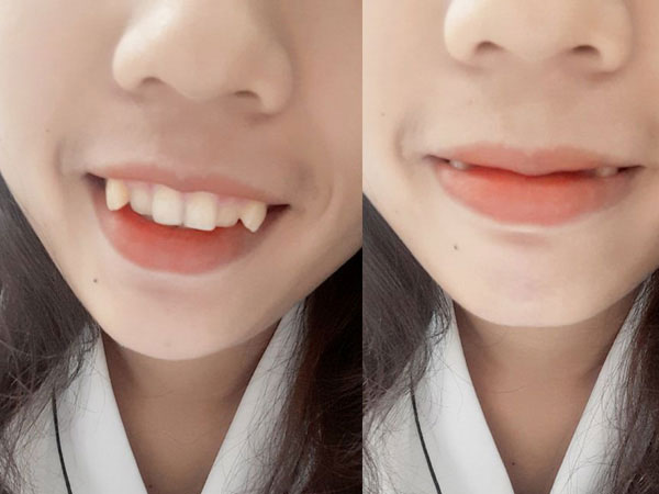 Đến chơi nhà người yêu, cô gái phát điên vì mẹ bạn trai chê "răng khấp khểnh như ma cà rồng"