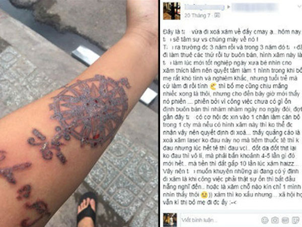 Xóa hình xăm vì khó tìm việc, chàng trai khuyên bạn trẻ "nghĩ kĩ rồi mới xăm"