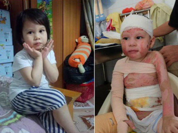 Hành trình hồi phục kỳ diệu của bé gái 5 tuổi bị bỏng cồn do nhân viên nhà hàng sơ ý