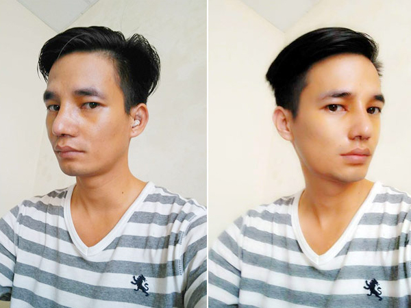 Lệ Rơi tháo băng mũi, lộ diện hình ảnh đẹp như soái ca