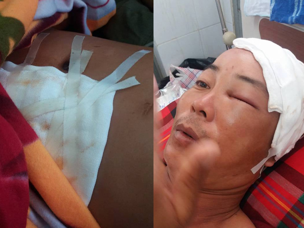 Đắk Lắk: Hai công an xã xô xát, một người bị chấn thương sọ não