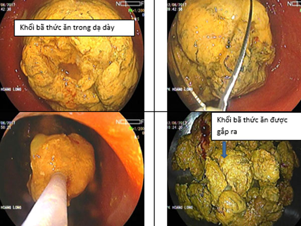 Cảnh báo: Uống tinh bột nghệ không đúng cách gây tắc ruột