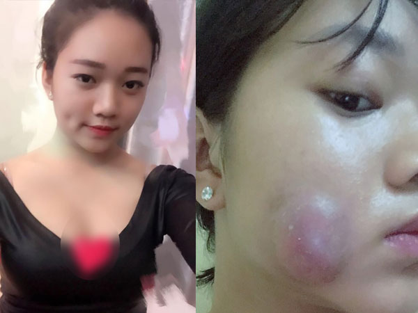 Muốn làm duyên bằng má lúm đồng tiền nhân tạo, cô gái trẻ bị áp-xe, má sưng như quả trứng