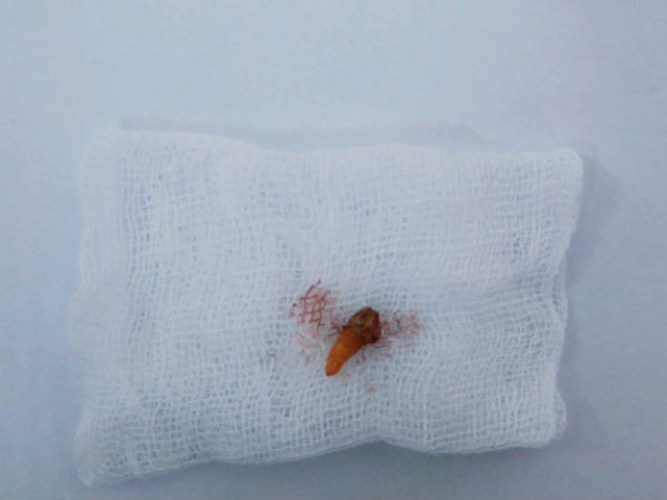 Hi hữu: Răng mọc trong mũi người phụ nữ 38 tuổi