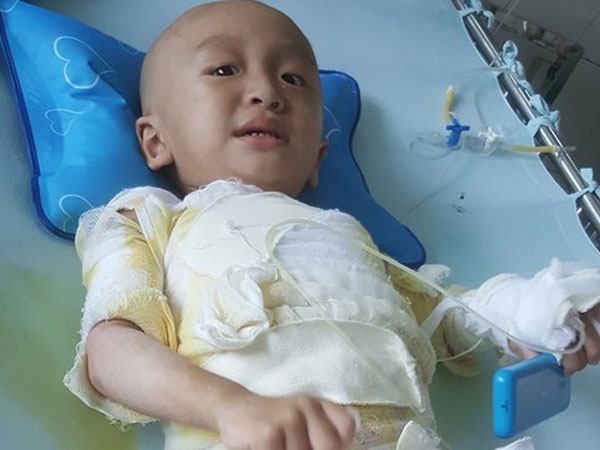Đau đớn bé trai 18 tháng tuổi bị bỏng toàn thân vì ngã vào nồi nước nóng ở đám cưới