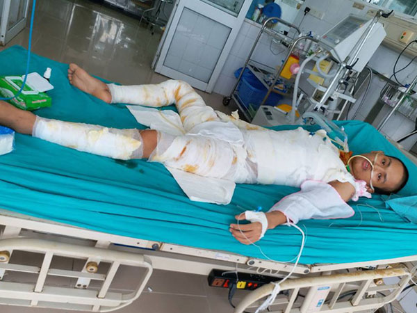 Hơn 20 ngày giành lại sự sống của chàng trai bị cháy ở xưởng bánh kẹo khiến 8 người tử vong