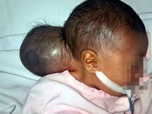 Bé gái mang khối u quái dị trông như có 2 đầu bị mẹ bỏ rơi khi đưa đến bệnh viện một ngày